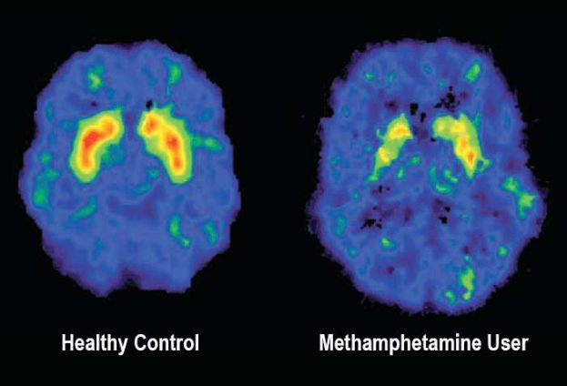 Zwei MRI-Gehirn-Scans nebeneinander, beschriftet mit "gesunder Kontroll" und "Methamphetamin-Nutzer" respectively, mit dem Text "Methamphetamin-Nutzer vs. gesunder Kontroll" unten.
